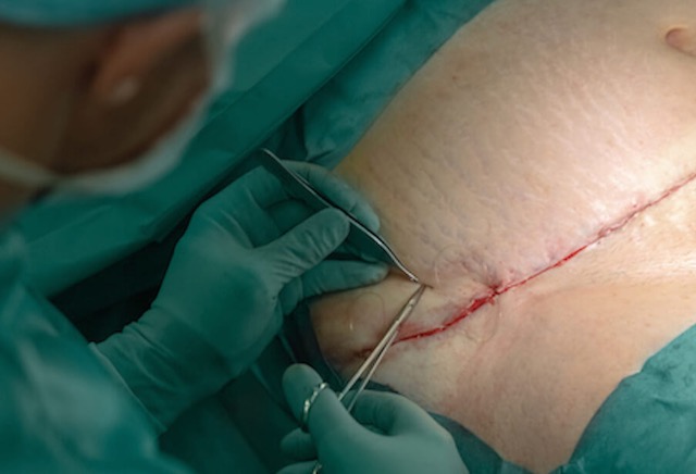 Lýtaaðgerðir eftir mikið þyngdartap